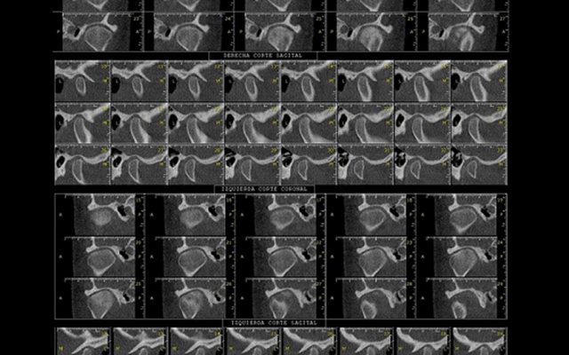 Cortes de un estudio CBCT de alta resolución