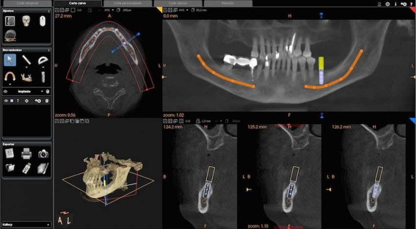 Software de planificación 3D mostrando la reconstrucción tridimensional de un estudio CBCT