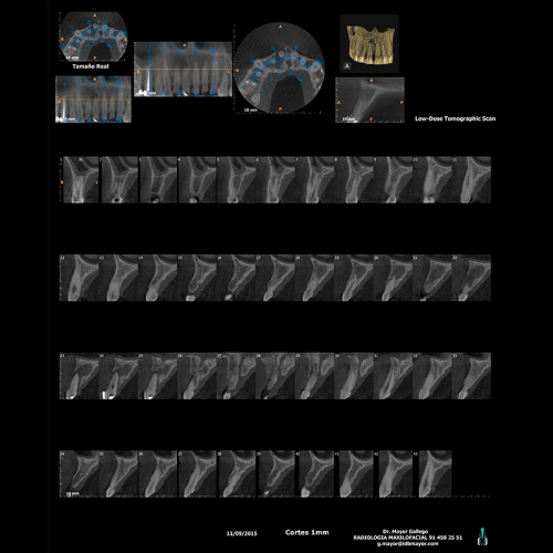 Cortes tomográficos de un estudio CBCT de baja dosis
