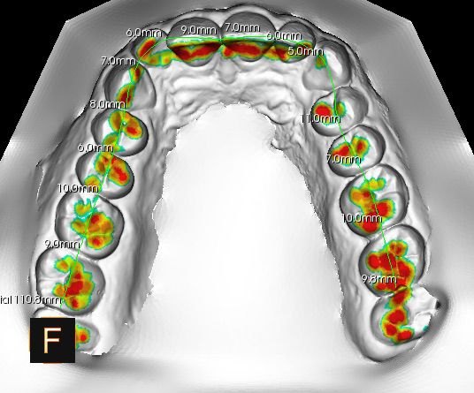 Escaneado intraoral 3D de la arcada dental realizado con el escáner iTero