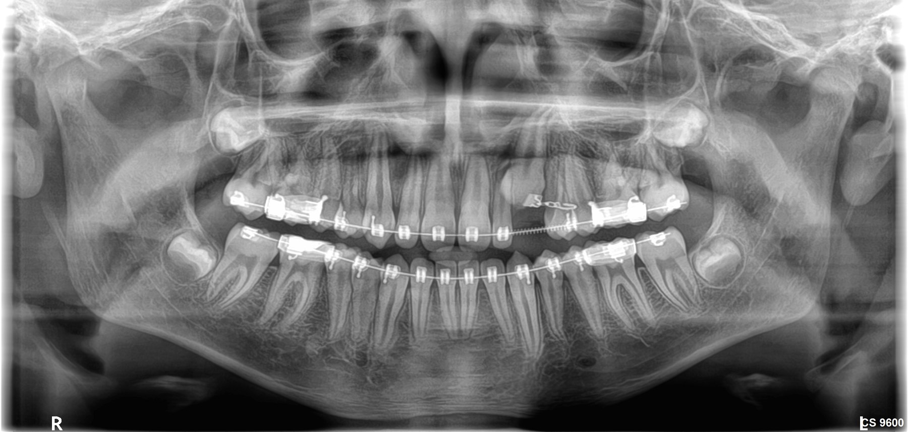 Ortopantomografía (radiografía panorámica digital) realizada con equipo CS 9600